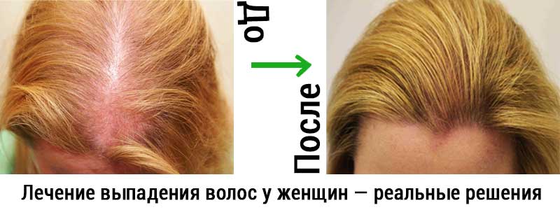 Лечение выпадения волос женщин — в этой статье вы найдёте реальные решения для вашей ситуации